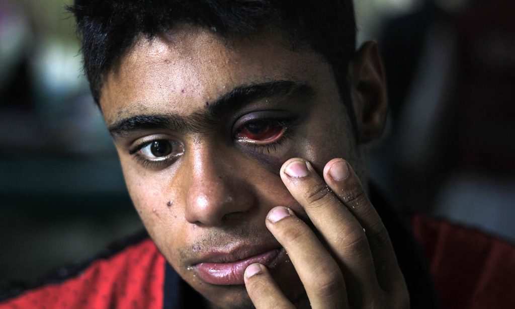 A pellet injured boy at the ophthalmology ward of Shri Maharaja Hari Singh Hospital (SMHS) in Srinagar. Photograph by Ahmer Khan/Dawn