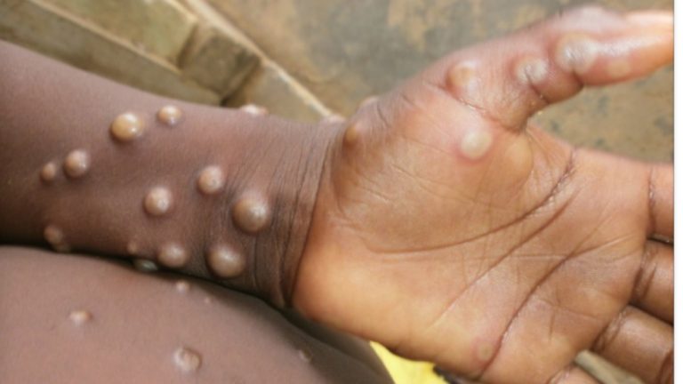 No urgent need for mass monkeypox vaccinations, says WHO